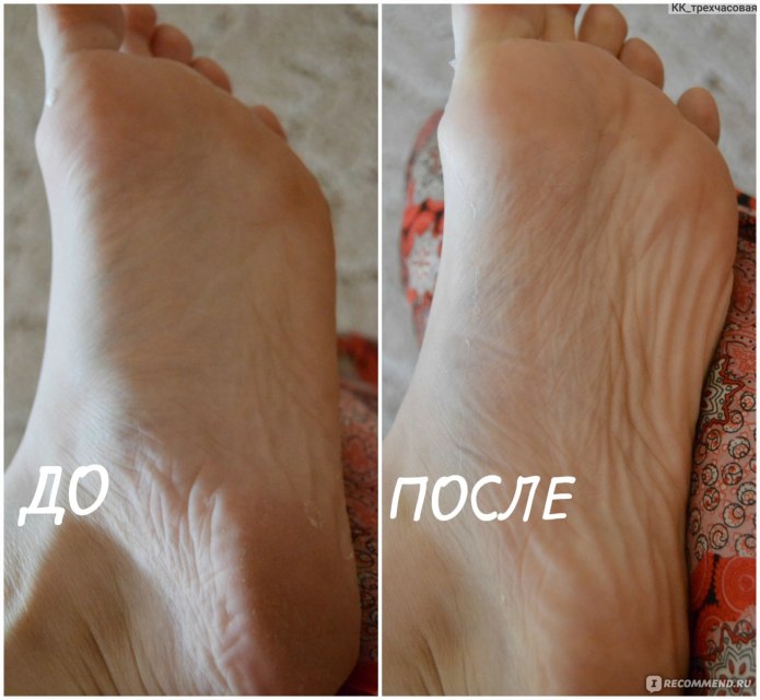 Ночные ортезы (брейсы)