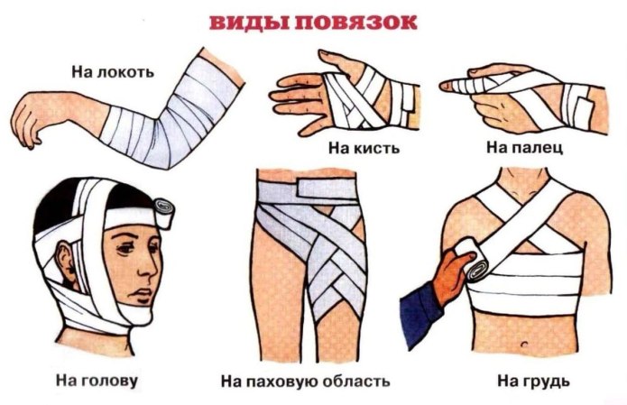 Наложение повязки на конечность алгоритм