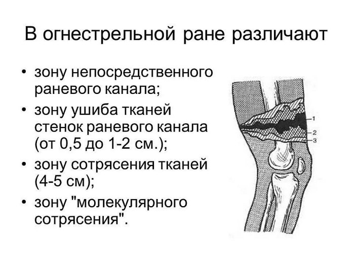 Зоны повреждения при огнестрельных ранения