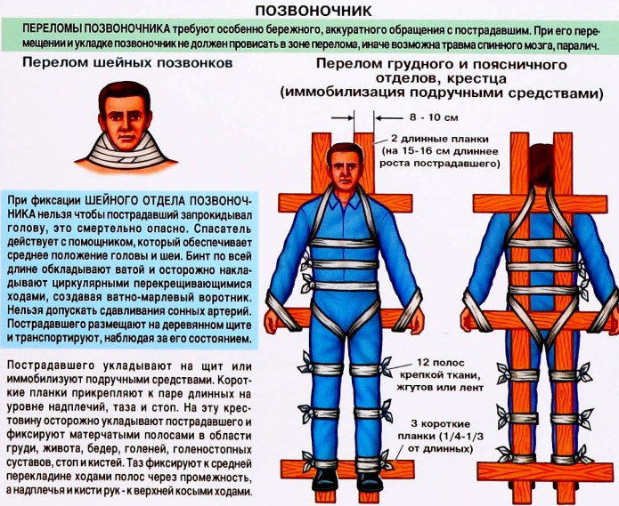 Иммобилизация при переломе позвоночника