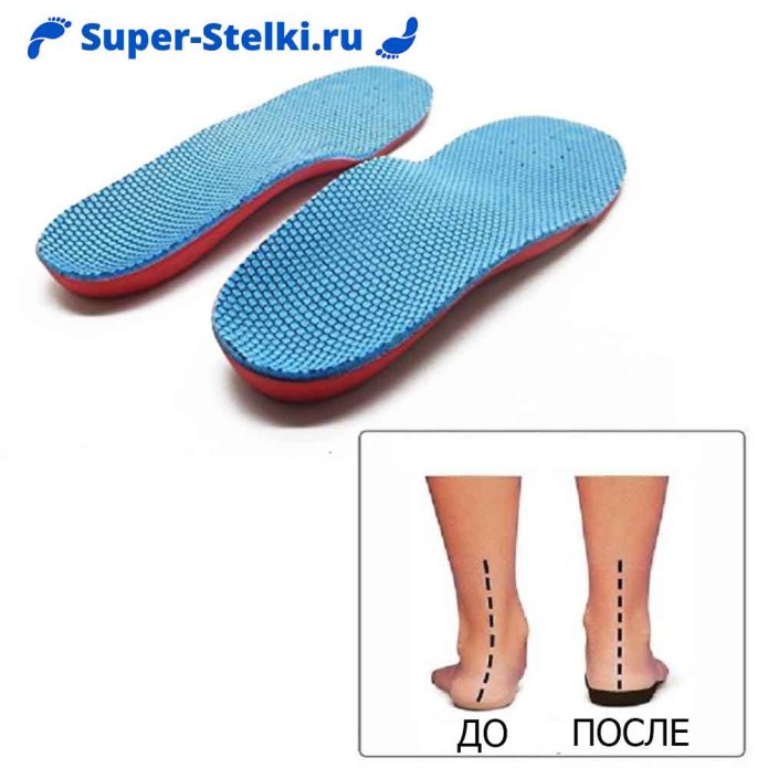 Ортопедические стельки плоскостопие